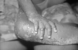 WHO convenes an emergency meeting of experts on monkeypox: what is known about the disease